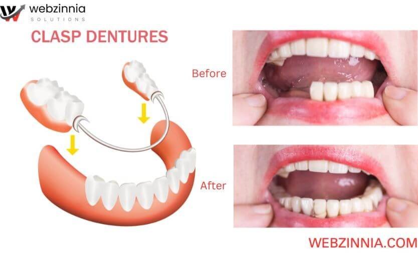 Dental marketing before-and-after photos: clasp dentures with a patient's smile before and after treatment